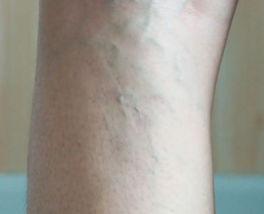 feetveins