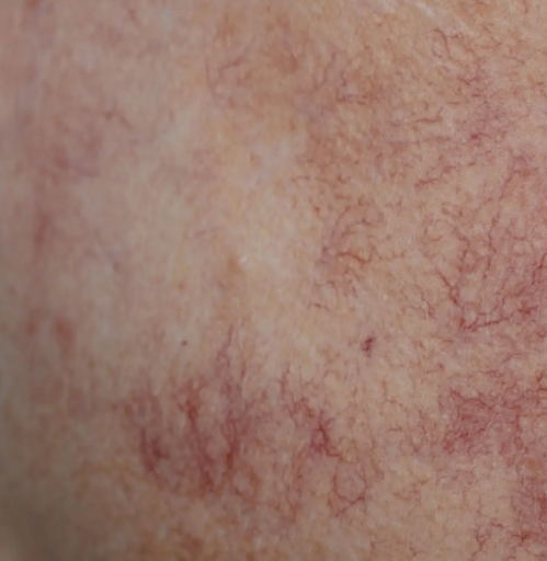 varicose veins